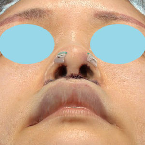 「鼻孔縁下降術」「人中短縮」　新宿ラクル美容外科クリニック　３０代女性　手術直後　７月２３日