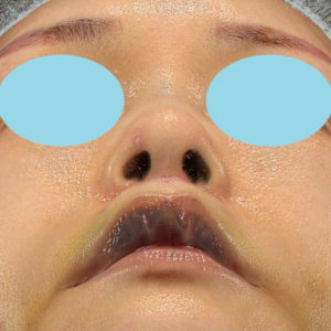 「鼻孔縁下降術」「人中短縮」　新宿ラクル美容外科クリニック　３０代女性　手術後１週間目　７月２３日