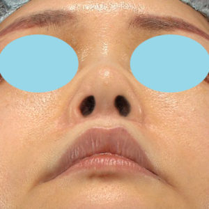 「鼻孔縁下降術」「人中短縮」　新宿ラクル美容外科クリニック　３０代女性　手術後１２ヶ月目　７月２３日