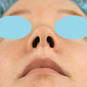 「鼻孔縁下降術」　新宿ラクル美容外科クリニック　３０代女性　手術後１２ヶ月目　２月１２日