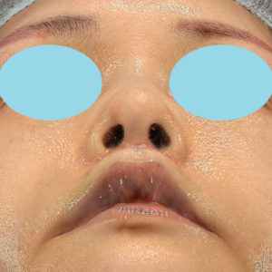 「鼻孔縁下降術」「人中短縮」　新宿ラクル美容外科クリニック　３０代女性　手術後１ヶ月目　７月２３日