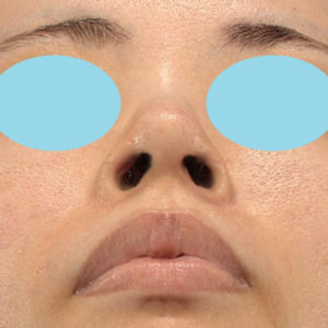 「鼻孔縁下降術」　新宿ラクル美容外科クリニック　３０代女性　手術後２ヶ月目　７月１７日