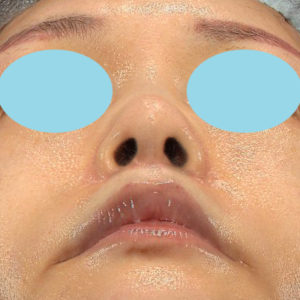 「鼻孔縁下降術」「人中短縮」　新宿ラクル美容外科クリニック　３０代女性　手術後３ヶ月目　７月２３日