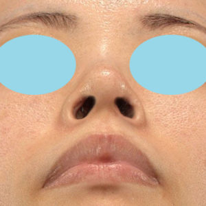 「鼻孔縁下降術」　新宿ラクル美容外科クリニック　３０代女性　手術後３ヶ月目　８月８日