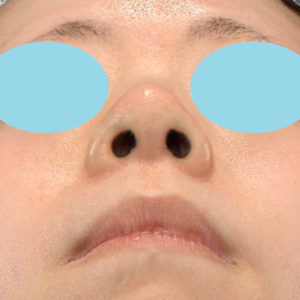 「小鼻縮小+α＋鼻尖縮小（close法）」　新宿ラクル美容外科クリニック　４０代女性　手術後６ヶ月目　１０月５日