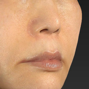 「鼻孔縁下降術」「人中短縮」　新宿ラクル美容外科クリニック　３０代女性　手術前　７月２３日