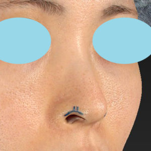 「鼻孔縁下降術」　新宿ラクル美容外科クリニック　３０代女性　デザイン　７月１７日