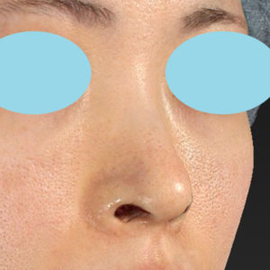「鼻孔縁下降術」　新宿ラクル美容外科クリニック　３０代女性　手術直後　７月１７日