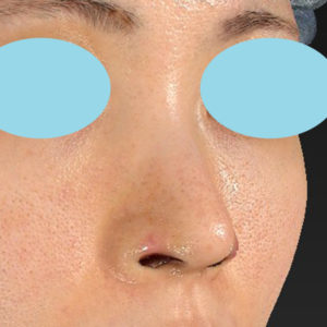 「鼻孔縁下降術」　新宿ラクル美容外科クリニック　３０代女性　手術後１週間目　７月１７日