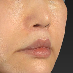 「鼻孔縁下降術」「人中短縮」　新宿ラクル美容外科クリニック　３０代女性　手術後１２ヶ月目　７月２３日