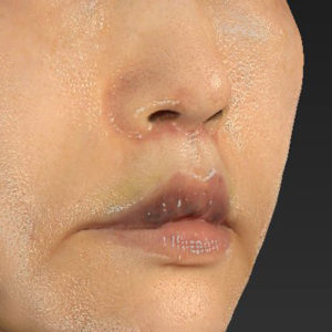 「鼻孔縁下降術」「人中短縮」　新宿ラクル美容外科クリニック　３０代女性　手術後１ヶ月目　７月２３日