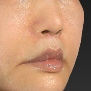 「鼻孔縁下降術」「人中短縮」　新宿ラクル美容外科クリニック　３０代女性　手術後６ヶ月目　７月２３日