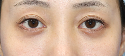 新宿ラクル美容外科クリニック　山本厚志　下眼瞼下制術（グラマラスライン形成術（皮膚切開法））+目尻切開+目頭切開　手術後１２ヶ月目　１１月２７日