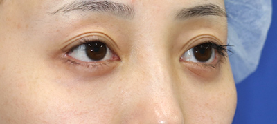 新宿ラクル美容外科クリニック　山本厚志　下眼瞼下制術（グラマラスライン形成術（皮膚切開法））+目尻切開+目頭切開　手術後１２ヶ月目　１１月２７日