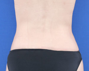 新宿ラクル美容外科クリニック　山本厚志　「ライポライフ脂肪吸引（腹部全体＋腰）」　手術後２ヶ月目　８月６日