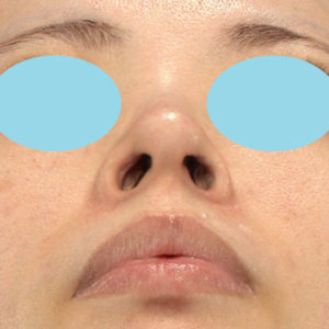 「鼻孔縁下降術」　新宿ラクル美容外科クリニック　３０代女性　手術後６ヶ月目　１１月４日