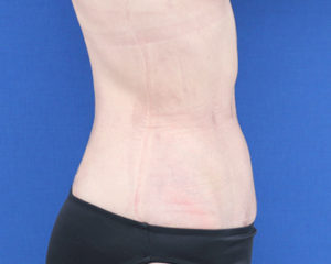 新宿ラクル美容外科クリニック　山本厚志　「ライポライフ脂肪吸引（腹部全体＋腰）」　手術後１ヶ月目　８月６日