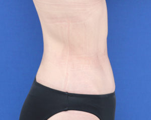 新宿ラクル美容外科クリニック　山本厚志　「ライポライフ脂肪吸引（腹部全体＋腰）」　手術後２ヶ月目　８月６日