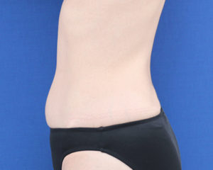 新宿ラクル美容外科クリニック　山本厚志　「ライポライフ脂肪吸引（腹部全体＋腰）」　手術前　８月６日