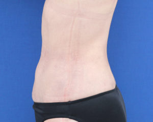 新宿ラクル美容外科クリニック　山本厚志　「ライポライフ脂肪吸引（腹部全体＋腰）」　手術後１ヶ月目　８月６日