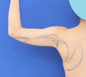 新宿ラクル美容外科クリニック　山本厚志　「ライポライフ脂肪吸引（二の腕+背中上部）」　デザイン　９月４日