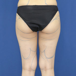 新宿ラクル美容外科クリニック　山本厚志　「ライポライフ脂肪吸引（お尻＋太もも全体＋ひざ周り）」　デザイン　９月３日