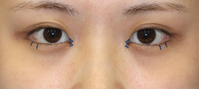 新宿ラクル美容外科クリニック　山本厚志　目頭切開＋下眼瞼下制術（たれ目術）　デザイン　９月１７日