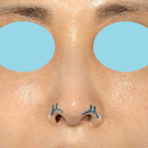 「鼻孔縁下降術」　新宿ラクル美容外科クリニック　５０代女性　デザイン　９月２７日