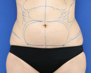 新宿ラクル美容外科クリニック　山本厚志　「ライポライフ脂肪吸引（腹部全体＋腰）」　デザイン　９月３０日