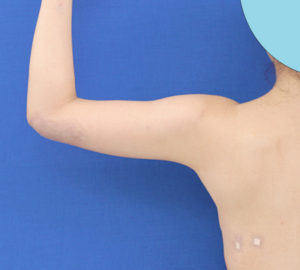 新宿ラクル美容外科クリニック　山本厚志　「ライポライフ脂肪吸引（二の腕+背中上部）」　手術直後　９月４日