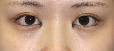 新宿ラクル美容外科クリニック　山本厚志　目頭切開＋下眼瞼下制術（たれ目術）　手術直後　９月１７日