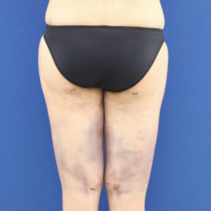 新宿ラクル美容外科クリニック　山本厚志　「ライポライフ脂肪吸引（お尻＋太もも全体＋ひざ周り）」　手術直後　９月１９日