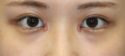 新宿ラクル美容外科クリニック　山本厚志　目頭切開＋下眼瞼下制術（たれ目術）　手術後１週間目　９月１７日