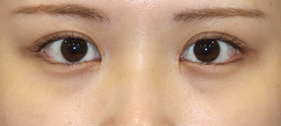 新宿ラクル美容外科クリニック　山本厚志　目頭切開＋下眼瞼下制術（たれ目術）　手術後１２ヶ月目　９月１７日