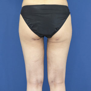 新宿ラクル美容外科クリニック　山本厚志　「ライポライフ脂肪吸引（お尻＋太もも全体＋ひざ周り）」　手術後１ヶ月目　９月３日