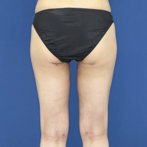 新宿ラクル美容外科クリニック　山本厚志　「ライポライフ脂肪吸引（お尻＋太もも全体＋ひざ周り）」　手術後２ヶ月目　９月３日