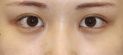 新宿ラクル美容外科クリニック　山本厚志　目頭切開＋下眼瞼下制術（たれ目術）　手術後２ヶ月目　９月１７日