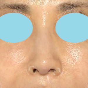 「鼻孔縁下降術」　新宿ラクル美容外科クリニック　５０代女性　手術後２ヶ月目　９月２７日