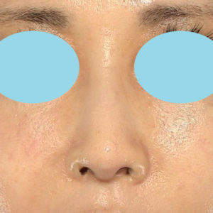「鼻孔縁下降術」　新宿ラクル美容外科クリニック　５０代女性　手術後３ヶ月目　１１月３日