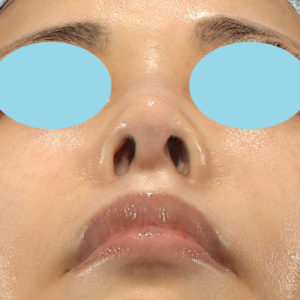 「鼻孔縁下降術」　新宿ラクル美容外科クリニック　５０代女性　手術前　９月２７日