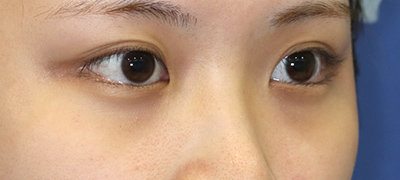 新宿ラクル美容外科クリニック　山本厚志　目頭切開＋下眼瞼下制術（たれ目術）　手術前　９月１７日
