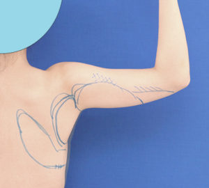 新宿ラクル美容外科クリニック　山本厚志　「ライポライフ脂肪吸引（二の腕+背中上部）」　デザイン　９月４日