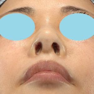 「鼻孔縁下降術」　新宿ラクル美容外科クリニック　５０代女性　手術直後　９月２７日