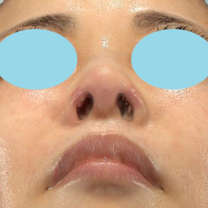 「鼻孔縁下降術」　新宿ラクル美容外科クリニック　５０代女性　手術後１週間目　９月２７日