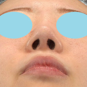 「耳介軟骨移植＋鼻尖縮小（close法）＋他院鼻プロテーゼ抜去」　新宿ラクル美容外科クリニック　２０代女性　手術後１２ヶ月目　３月８日