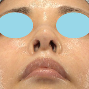 「鼻孔縁下降術」　新宿ラクル美容外科クリニック　５０代女性　手術後１ヶ月目　９月２７日