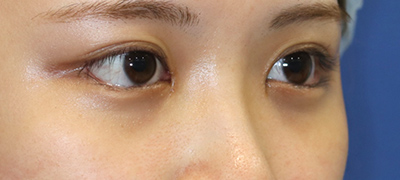 新宿ラクル美容外科クリニック　山本厚志　目頭切開＋下眼瞼下制術（たれ目術）　手術後１ヶ月目　９月１７日