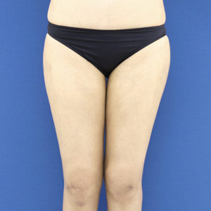 新宿ラクル美容外科クリニック　山本厚志　「ライポライフ脂肪吸引（お尻＋太もも全体＋ひざ周り）」　手術後１ヶ月目　９月１９日