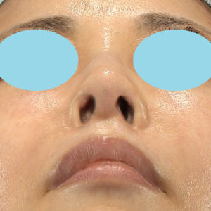 「鼻孔縁下降術」　新宿ラクル美容外科クリニック　５０代女性　手術後２ヶ月目　９月２７日