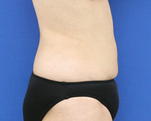 新宿ラクル美容外科クリニック　山本厚志　「ライポライフ脂肪吸引（腹部全体＋腰）」　手術後２ヶ月目　９月３０日